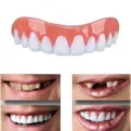 Silicone cosmetic denture veneer detail showing realistic teeth whitening before and after effect. - White