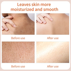 Before and after comparison of body glaze moisturizing effects on dry cracked skin