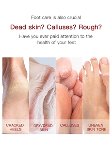 Detailed chart showing cracked heels, dry skin, calluses and uneven skin tone for foot care