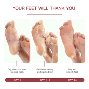 Exfoliating foot mask progress showing skin peeling from dry heels to smooth results