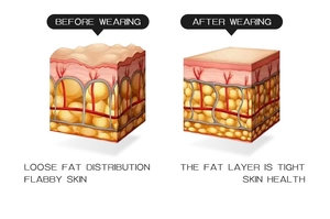 Comparison showing body sculpting effect on subcutaneous fat and skin firmness