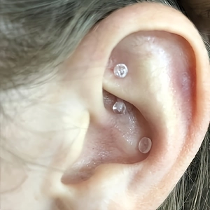 Transparent ear point stimulation patches for magnetic therapy shown on an ear