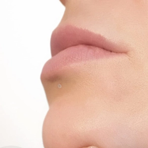 Detailed close-up of a 10mm ultra-thin invisible acne patch applied on chin skin area