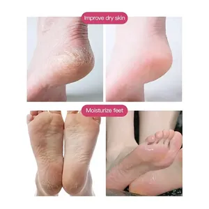 Détail montrant l'effet avant/après des chaussettes spa sur les talons secs et fendillés