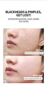 Comparación de resultados de exfoliación cutánea eficaz antes y después