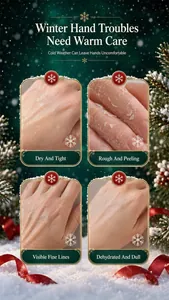 Vue détaillée des problèmes de peau sèche et squameuse pour crème mains de Noël hydratante