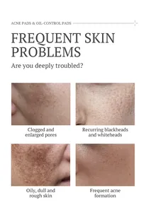 Detail page showing common skin issues like enlarged pores and acne for cotton pads