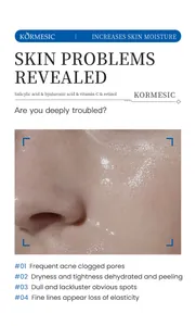Huidverzorgingsdetail voor KORMESIC Salicylzuur Serum toont acne en droge huid