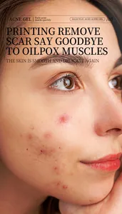 Primer plano de la piel facial con acné antes del tratamiento con gel de ácido salicílico
