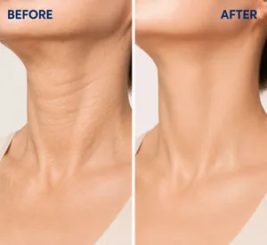 Side-by-side comparison showing neck wrinkle reduction before and after cream use.