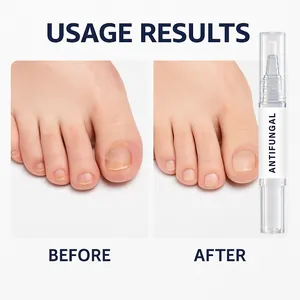 Resultaten voor en na het gebruik van de pen voor behandeling van schimmelnagels