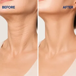 Neck barrier repair cream showing before and after effect comparison for wrinkles