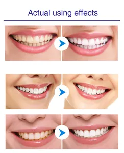 Pluma de blanqueamiento dental antes y después con resultados brillantes visibles