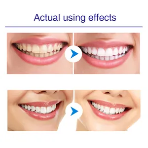 Resultados de antes y después del lápiz blanqueador dental profesional para manchas