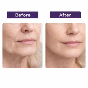Confronto prima e dopo dell'effetto della crema lifting 3D sulle rughe del viso