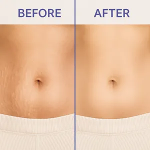 Resultados visibles antes y después de reducción de estrías con crema para abdomen