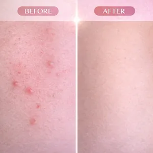 Cyperus Rotundus Oil roller essence showing before and after skin repair results
