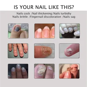 Exemples d'ongles abîmés comme l'épaississement et la décoloration pour réparation