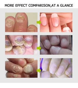 Comparaison avant et après du traitement par crème réparatrice pour ongles abîmés