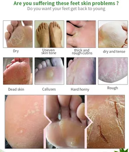Detailed visual guide of foot skin conditions such as dry skin, calluses and dead skin