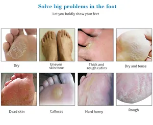 Detailed view of foot skin conditions like dry skin, calluses, and dead skin