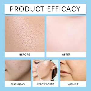 Skin transformation efficacy chart showing before and after microneedle treatment results