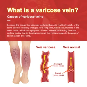 Diagrama explicativo sobre las causas de las varices y válvulas venosas dañadas