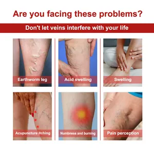 Síntomas de varices incluyendo hinchazón, entumecimiento y dolor de piernas infografía