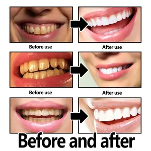 Comparación detallada antes y después del blanqueamiento dental mostrando resultados