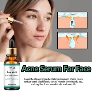 Dettaglio del siero acne Hoygi con diagramma di pulizia pori e scena d'uso modella