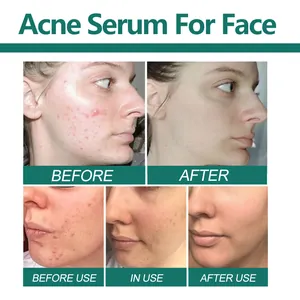 Confronto dettagliato prima e dopo del siero anti-acne per una pelle più pulita