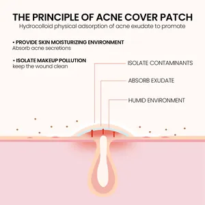 Gedetailleerd diagram over de werking van de hydrocolloïde acne pleister