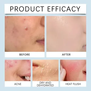 Comparison chart showing Hoygi Hyaluronic Acid Serum efficacy on acne and dry skin.