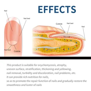 Gedetailleerd diagram van nagelherstel bij onychomycosebehandeling
