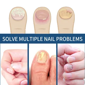 Infographic met diverse nagelproblemen zoals schimmel en breuk voor herstelpatches