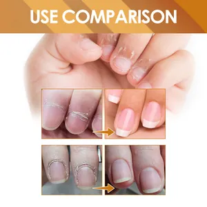 Visual use comparison showing instant cuticle care gel for repairing damaged nails and skin