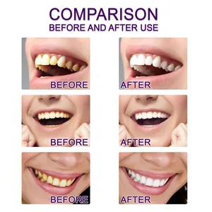 Comparison chart showing before and after teeth whitening results with V34 purple pen