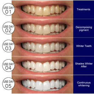 5-day teeth whitening strips results showing progressive removal of stains and yellowing.