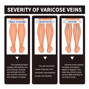 Detailed severity chart of varicose veins for chamomile leg massage oil