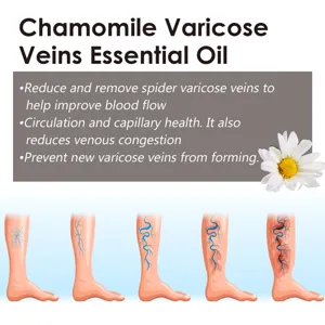 Chamomile essential oil for varicose veins with progressive leg stage diagrams and benefits