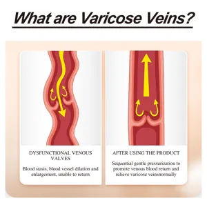 Anatomical diagram comparing dysfunctional venous valves and healthy blood flow in legs.