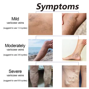 Chamomile leg essential oil for varicose veins symptoms guide