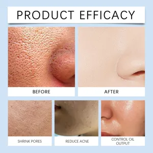 Vista detallada de la eficacia cutanea para reduccion de poros y acne en el rostro.