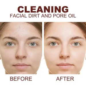 Gel Exfoliant Viso Nettoyage Profond Pores Contrôle Sébum Élimination Peaux Mortes Soin Visage