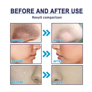 Mascarilla peel off de limpieza profunda de carbón antes y después poros puntos negros.