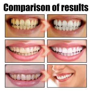 Teeth whitening result comparison detail showing clean and bright results.