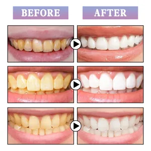 Teeth whitening pen effect comparison detail showing before and after results clearly.