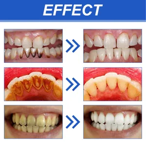 Teeth whitening effect detail view showing stain removal and clean bright dental results.
