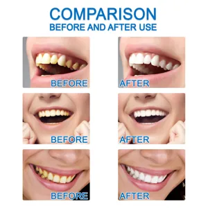 Teeth whitening essence detail showing before and after use comparison results clearly.