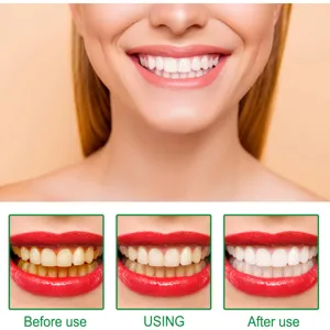 Professional teeth whitening effect comparison image showing results before and after use clearly.